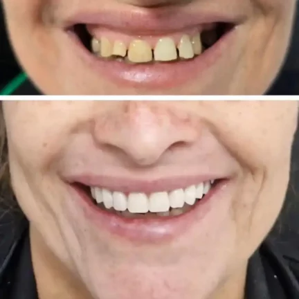 Extração Dentaria Complexa (1)